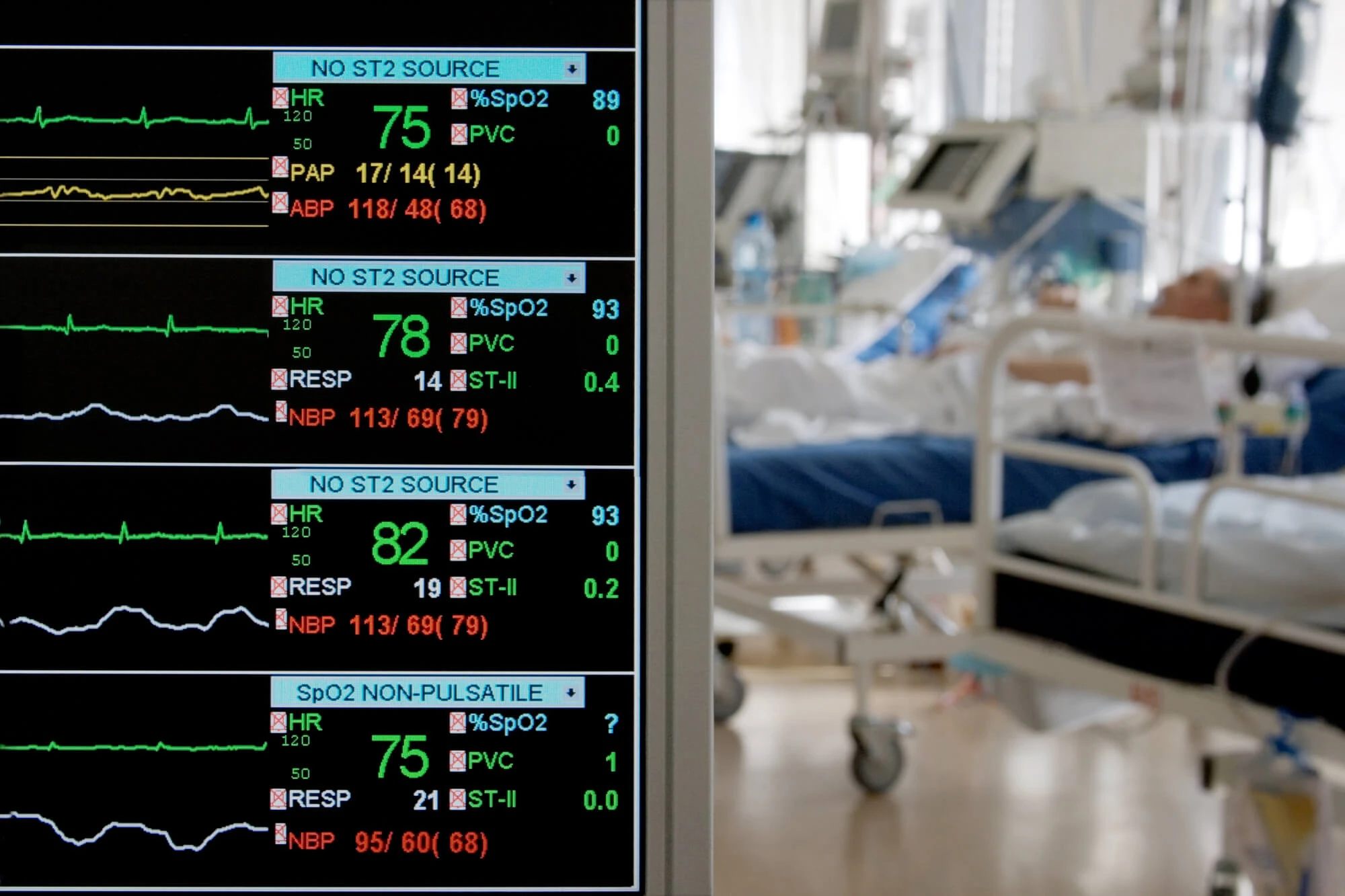 Eletromiografia de superfície: nova forma de avaliação de pacientes em UTI